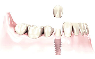 Single-Tooth Dental Implant A single-tooth implant replaces a missing tooth and preserves the bone integrity to prevent further deterioration.