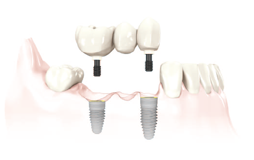 Dental Implants for Multiple Missing Teeth Dental implants for multiple missing teeth preserve the integrity of the bone as well as remaining teeth around the missing teeth.